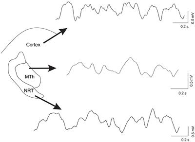 Oscillatory Activity in the Cortex, Motor Thalamus and Nucleus Reticularis Thalami in Acute TTX and Chronic 6-OHDA Dopamine-Depleted Animals